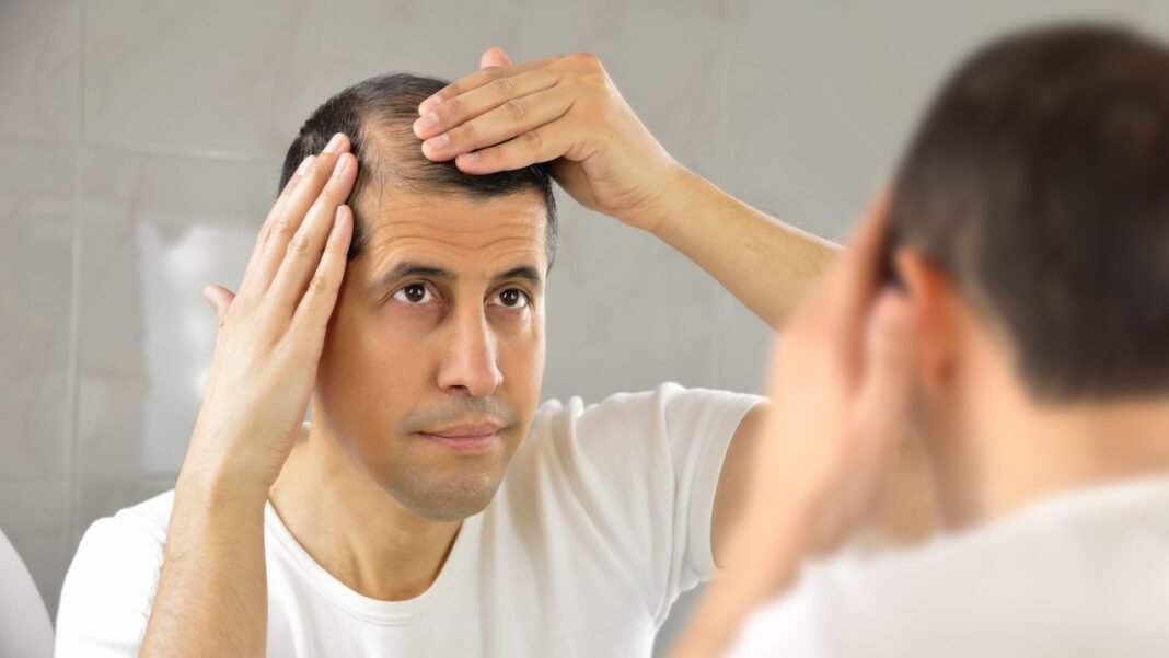 Frequently Asked Questions about Hair Transplant