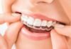 How To Enhance Your Smile And Overall Health With Clear Aligners